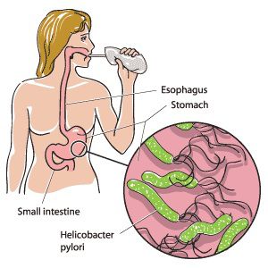 Helicobactrer-Pylori