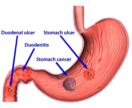 helicobacter_pylori_diseases